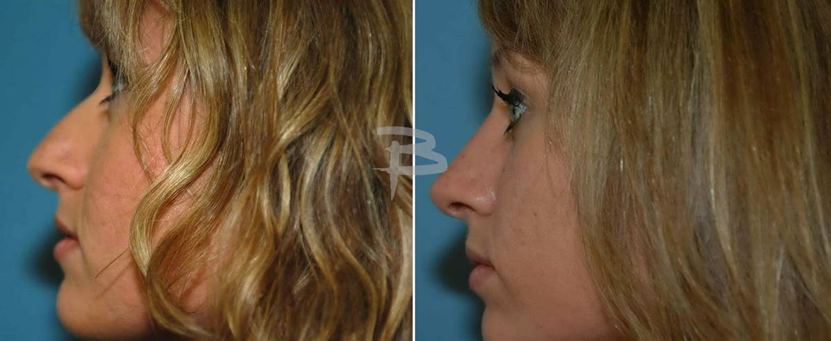 Rhinoplasty Before & After Gallery - Patient 192276899 - Image 1