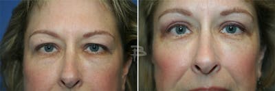 Blepharoplasty Before & After Gallery - Patient 192276903 - Image 1