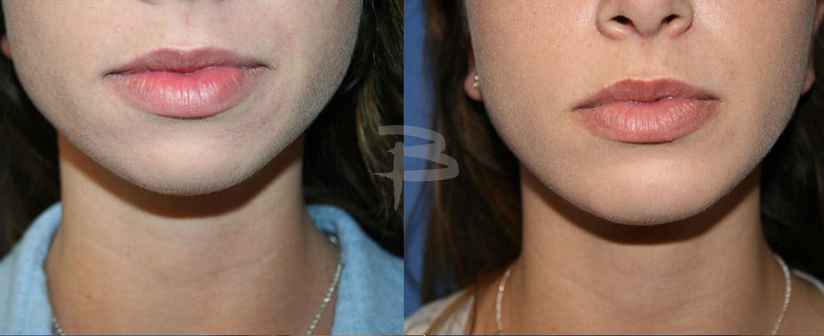 Facial Implants Before & After Gallery - Patient 192276901 - Image 1