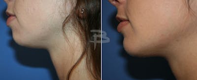 Facial Implants Before & After Gallery - Patient 192276906 - Image 1