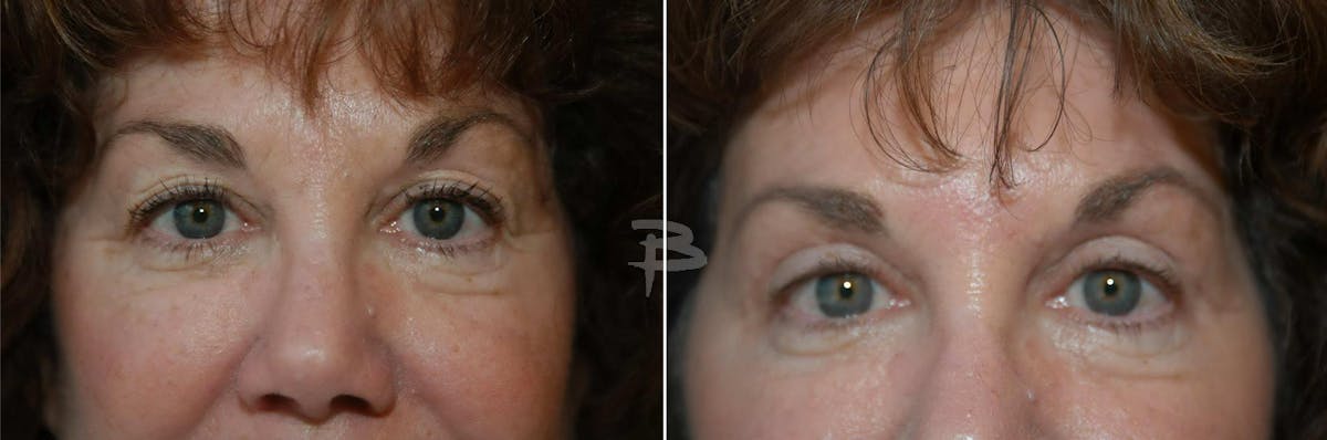 Blepharoplasty Before & After Gallery - Patient 192276907 - Image 1