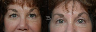 Blepharoplasty Before & After Gallery - Patient 192276907 - Image 1