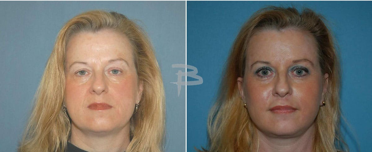Facial Implants Before & After Gallery - Patient 192276913 - Image 1