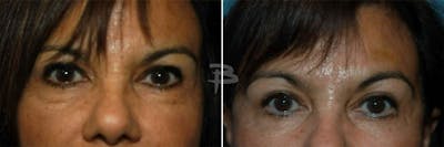 Blepharoplasty Before & After Gallery - Patient 192276915 - Image 1