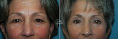 Blepharoplasty Before & After Gallery - Patient 192276917 - Image 1