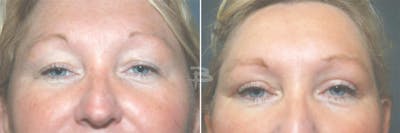 Blepharoplasty Before & After Gallery - Patient 192276919 - Image 1