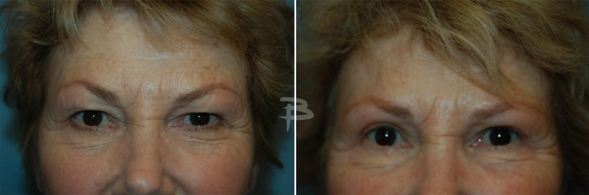 Blepharoplasty Before & After Gallery - Patient 192276937 - Image 1