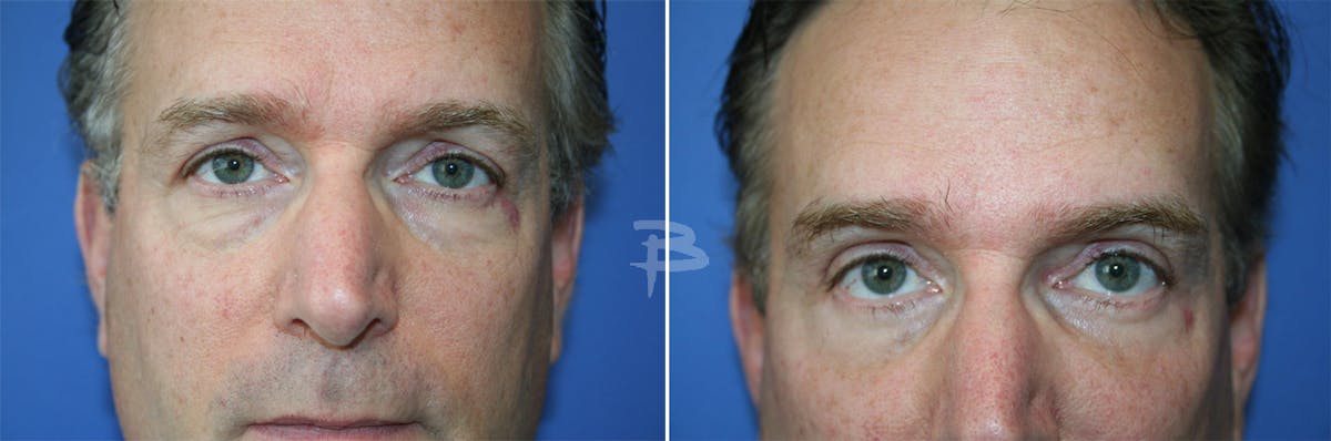 Blepharoplasty Before & After Gallery - Patient 192276962 - Image 1