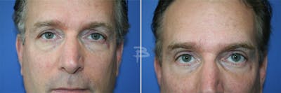 Blepharoplasty Before & After Gallery - Patient 192276962 - Image 1