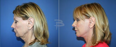 Simplicity Neck Lift Before & After Gallery - Patient 192276963 - Image 1