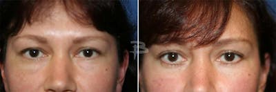 Blepharoplasty Before & After Gallery - Patient 192276964 - Image 1