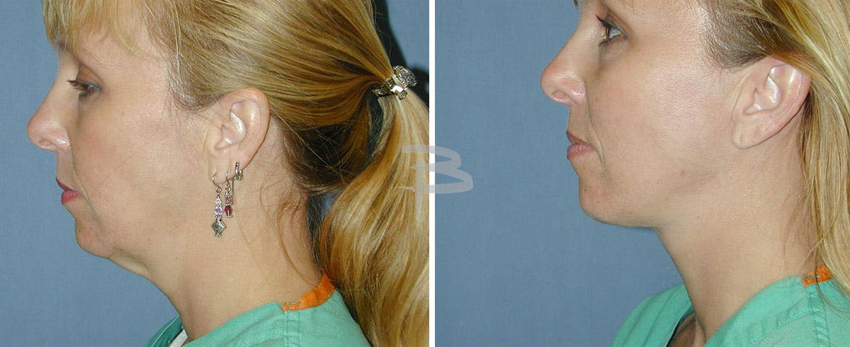 Simplicity Neck Lift Before & After Gallery - Patient 192276971 - Image 1