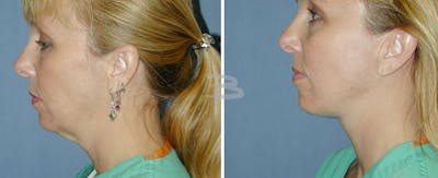 Simplicity Neck Lift Before & After Gallery - Patient 192276971 - Image 1