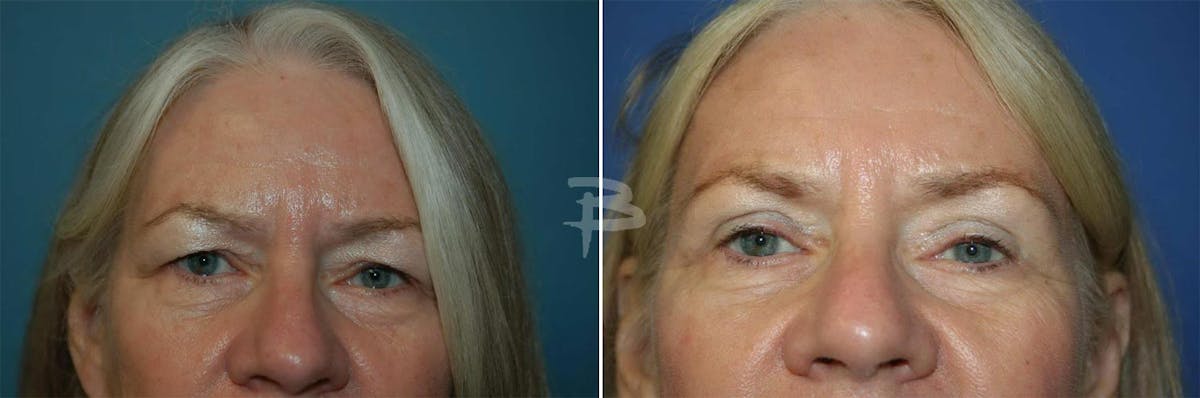 Blepharoplasty Before & After Gallery - Patient 192276973 - Image 1