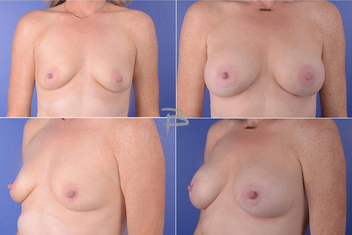Breast Augmentation Before & After Gallery - Patient 192276976 - Image 1
