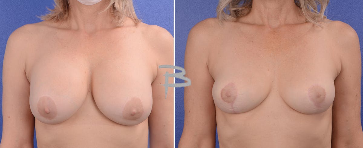 Breast Lift Before & After Gallery - Patient 192276987 - Image 1