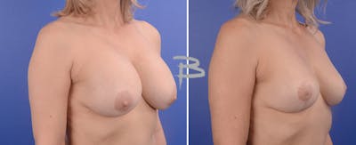 Breast Lift Before & After Gallery - Patient 192276991 - Image 1