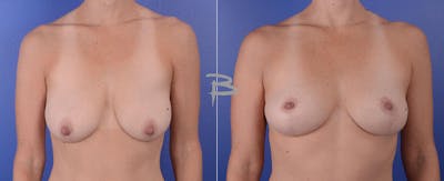 Breast Lift Before & After Gallery - Patient 192276998 - Image 1