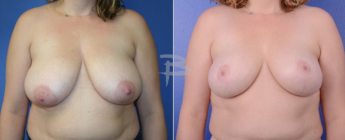 Breast Reduction Before & After Gallery - Patient 192277002 - Image 1