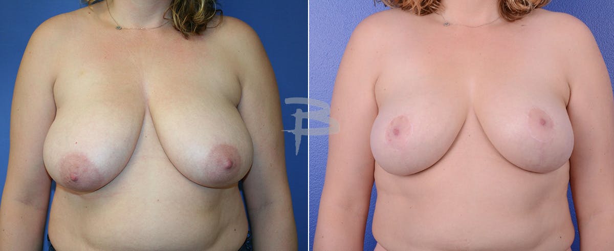 Breast Reduction Before & After Gallery - Patient 192277002 - Image 1