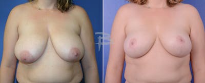 Breast Reduction Before & After Gallery - Patient 192277002 - Image 1