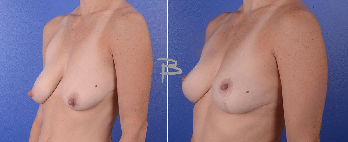 Breast Lift Before & After Gallery - Patient 192277008 - Image 1