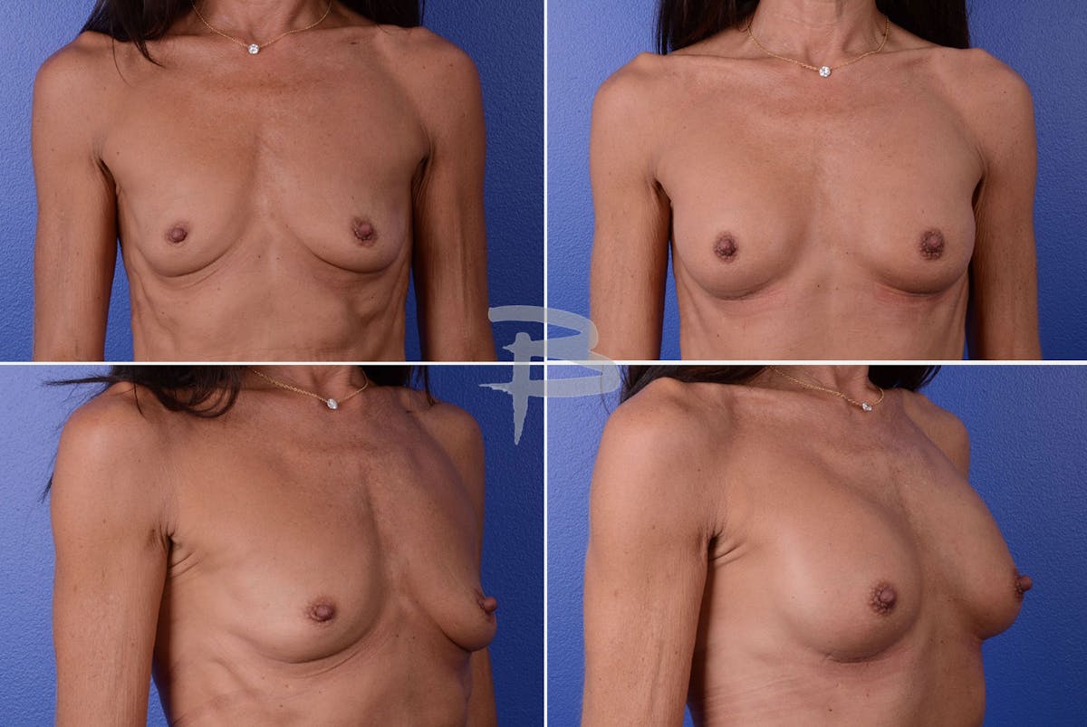 Breast Augmentation Before & After Gallery - Patient 192277007 - Image 1