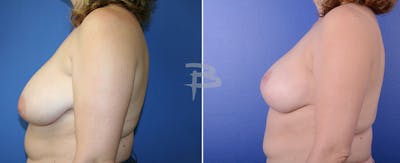 Breast Reduction Before & After Gallery - Patient 192277009 - Image 1