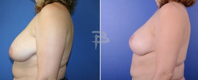 Breast Reduction Before & After Gallery - Patient 192277009 - Image 1