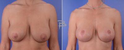 Breast Lift Before & After Gallery - Patient 192277013 - Image 1