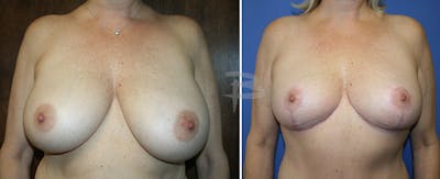 Breast Reduction Before & After Gallery - Patient 192277015 - Image 1