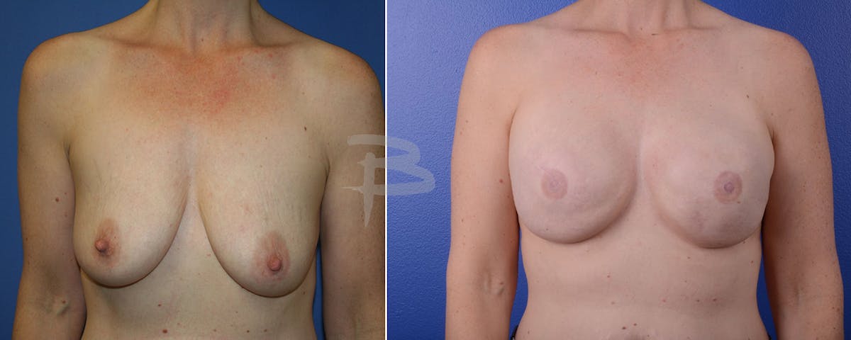 Breast Implant Reconstruction Before & After Gallery - Patient 192277017 - Image 1