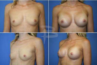 Breast Augmentation Before & After Gallery - Patient 192277020 - Image 1