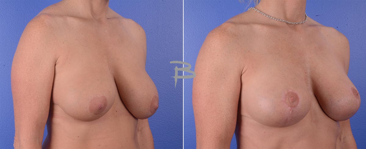 Breast Lift Before & After Gallery - Patient 192277018 - Image 1