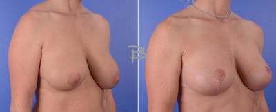 Breast Lift Before & After Gallery - Patient 192277018 - Image 1