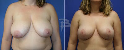 Breast Reduction Before & After Gallery - Patient 192277019 - Image 1
