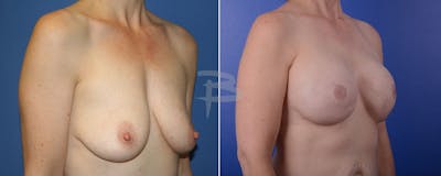 Breast Implant Reconstruction Before & After Gallery - Patient 192277021 - Image 1