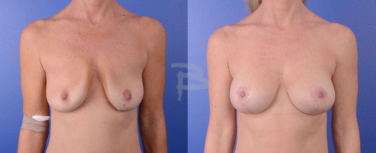 Breast Lift Before & After Gallery - Patient 192277022 - Image 1
