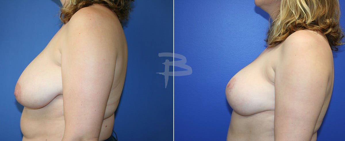 Breast Reduction Before & After Gallery - Patient 192277023 - Image 1