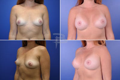 Breast Augmentation Before & After Gallery - Patient 192277026 - Image 1