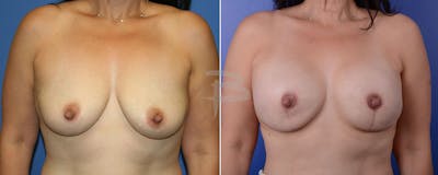 Breast Implant Reconstruction Before & After Gallery - Patient 192277025 - Image 1