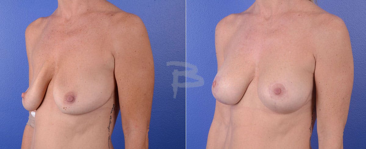 Breast Lift Before & After Gallery - Patient 192277027 - Image 1