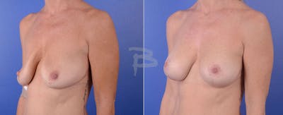 Breast Lift Before & After Gallery - Patient 192277027 - Image 1