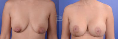 Breast Flap Reconstruction Before & After Gallery - Patient 192277029 - Image 1