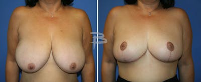 Breast Reduction Before & After Gallery - Patient 192277028 - Image 1