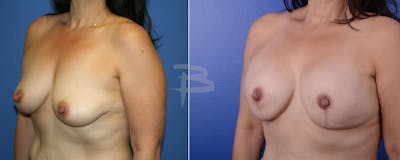 Breast Implant Reconstruction Before & After Gallery - Patient 192277030 - Image 1