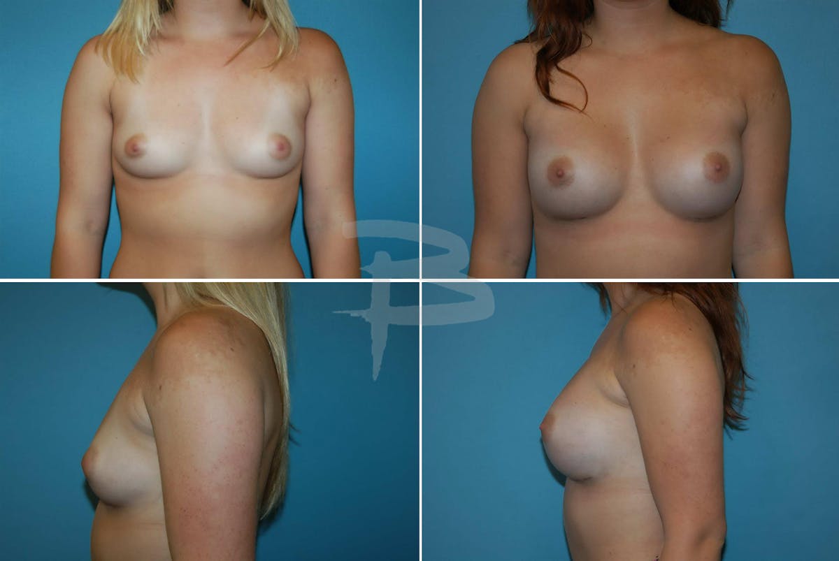 Breast Augmentation Before & After Gallery - Patient 192277034 - Image 1