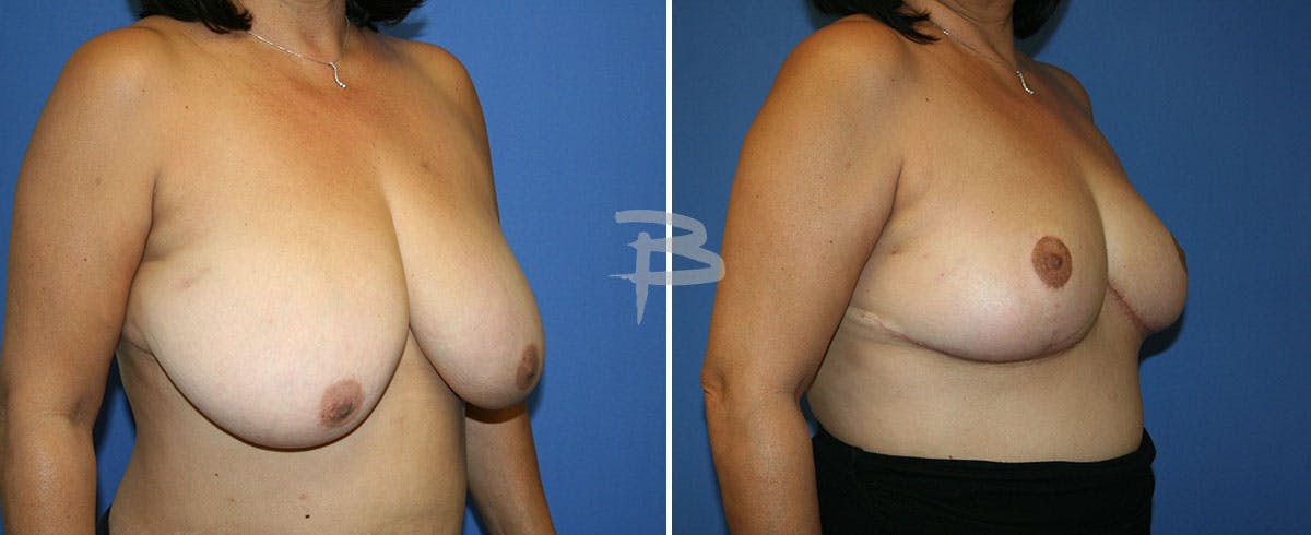 Breast Reduction Before & After Gallery - Patient 192277031 - Image 1