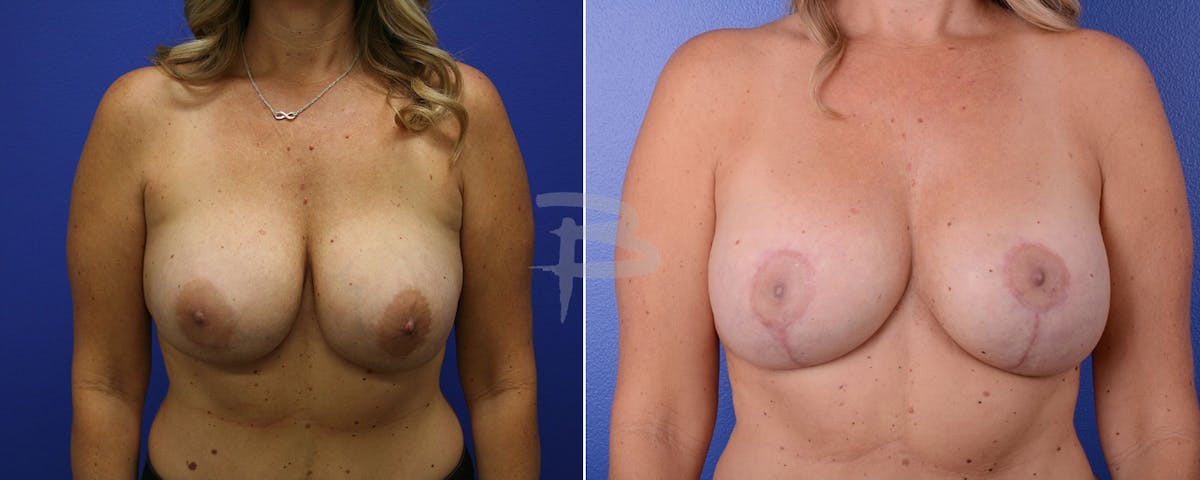 Breast Implant Reconstruction Before & After Gallery - Patient 192277040 - Image 1