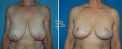Breast Reduction Before & After Gallery - Patient 192277041 - Image 1